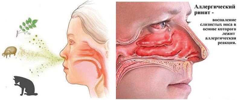 Аллергия на капли в нос: симптомы и лечение