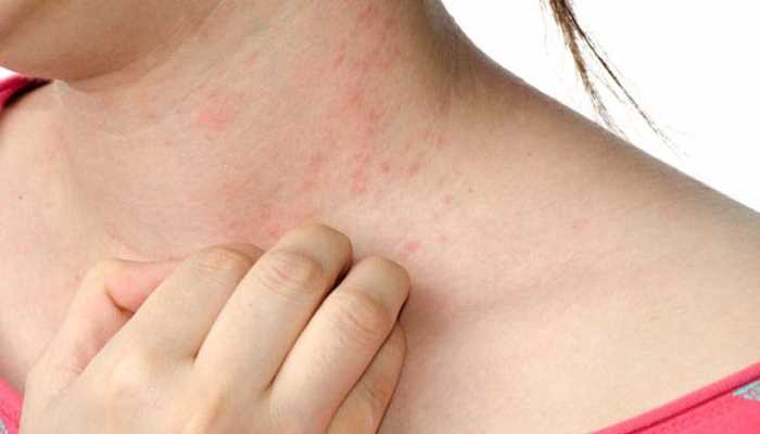 Аллергия на клеща Dermatophagoides farinae: что это и как с ней бороться