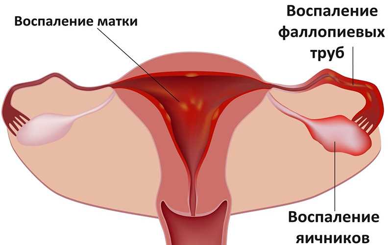  Анемия при месячных: причины, симптомы и методы лечения 