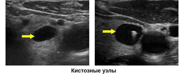 Анэхогенное аваскулярное образование в щитовидной железе: что это и как обнаружить?