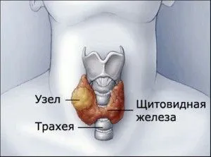 Анэхогенное аваскулярное образование в щитовидной железе: что это и как обнаружить?