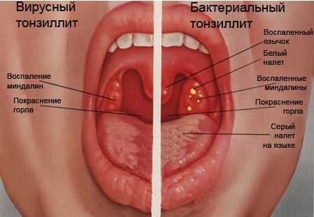 Симптомы