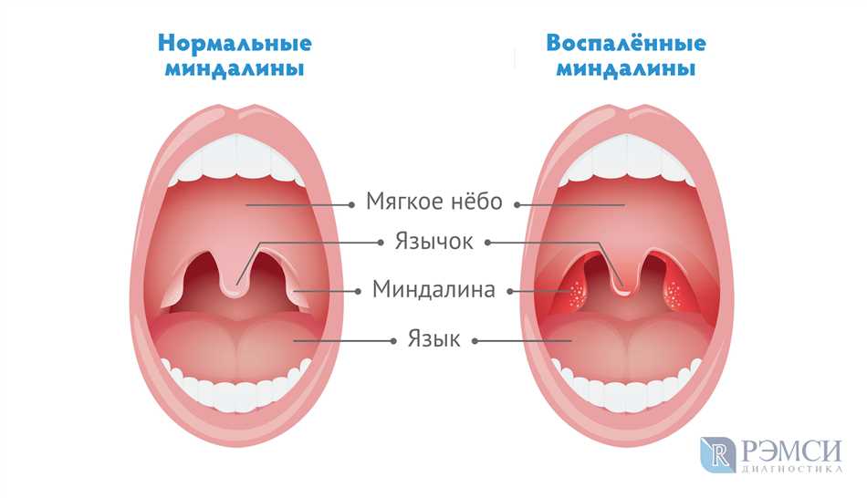 Ангина