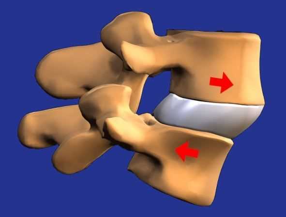 Антеролистез поясничного отдела: симптомы, причины, лечение