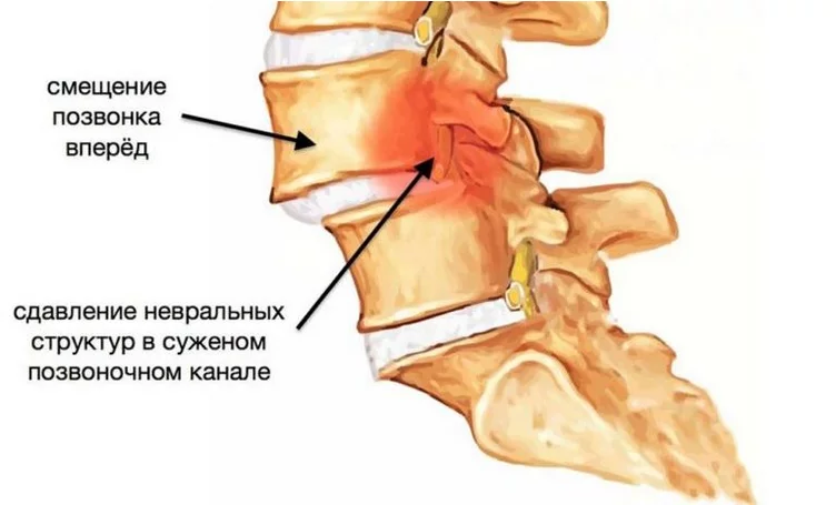 Симптомы антеролистеза поясничного отдела позвоночника