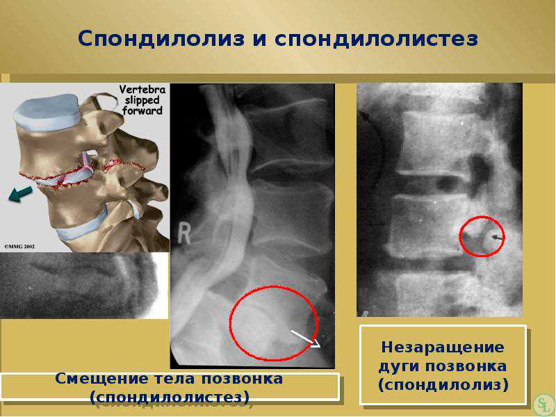 Антеспондилолистез L5 позвонка 1 степени: что это такое?