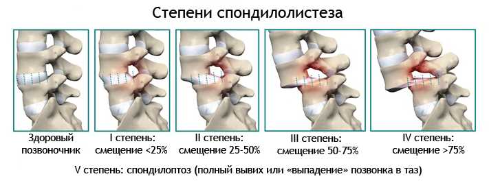 Антеспондилолистез L5 позвонка 1 степени: что это такое?