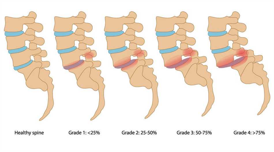 Антеспондилолистез L5 позвонка 1 степени: что это такое?