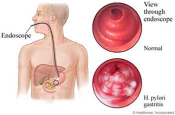 Роль IgM в диагностике Helicobacter pylori