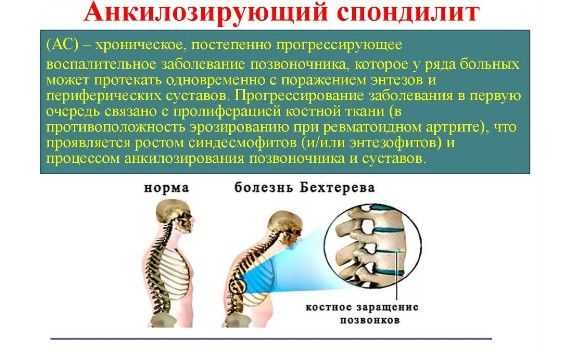 Связь антигена HLA В27 с воспалительными процессами