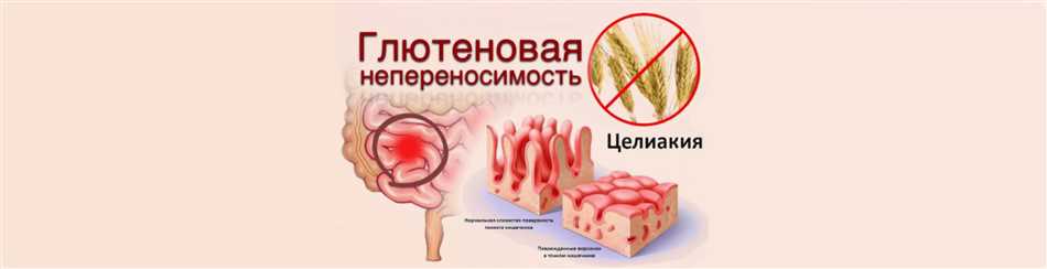 Антитела к глиадину IgG и IgA: какие они и зачем нужны