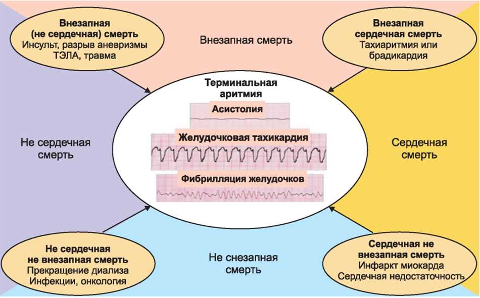 Причины асистолии