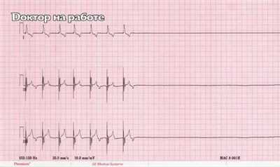 Асистолия: что это значит и каковы причины?