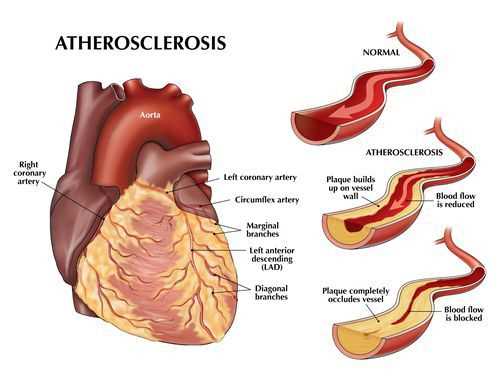 Атеросклеротический коронарокардиосклероз: определение и причины развития