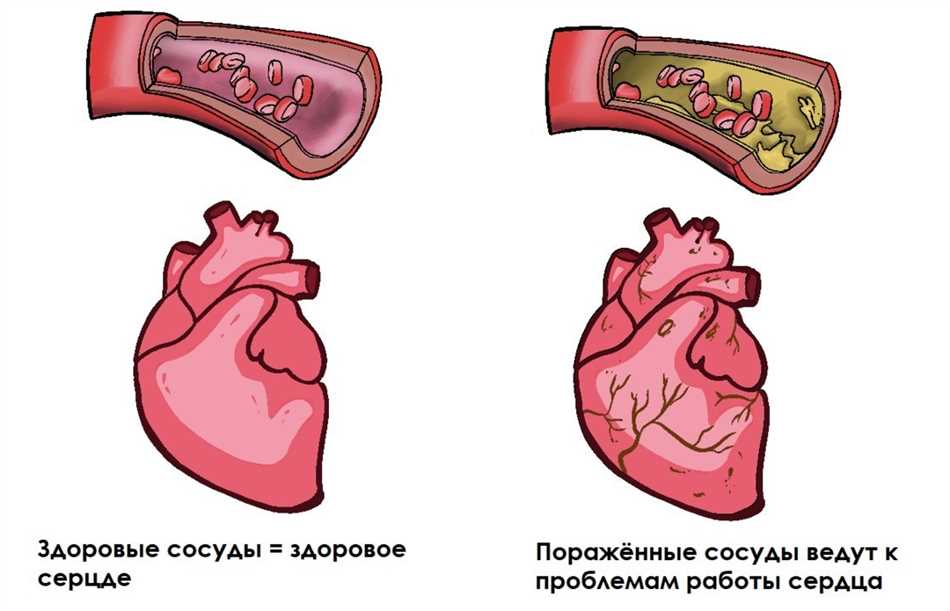 Атеросклероз левого желудочка: причины, симптомы и лечение