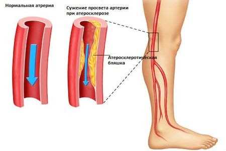 Причины атеросклероза левого желудочка