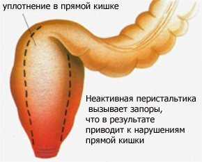 Причины атонии