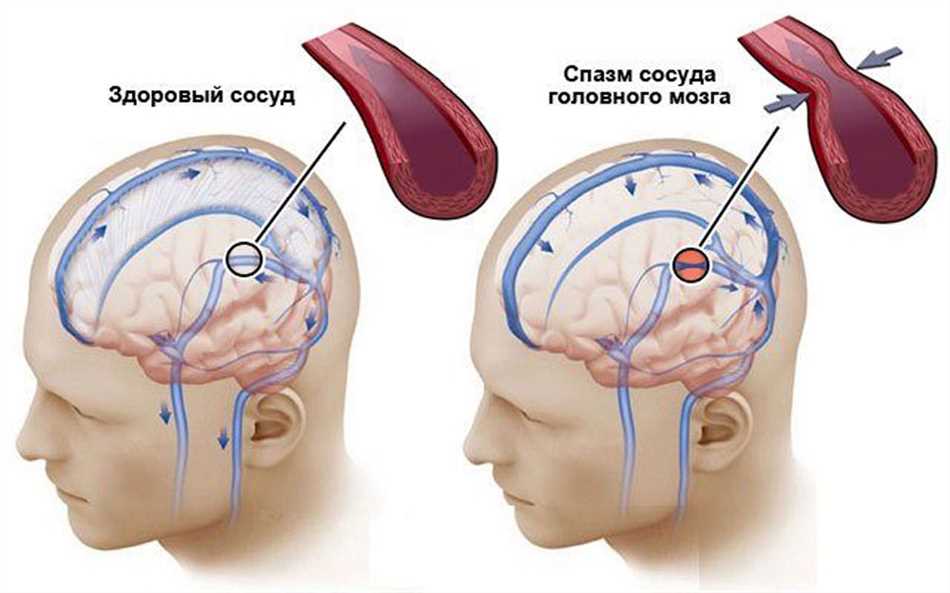 Причины кружения головы при ОРВИ