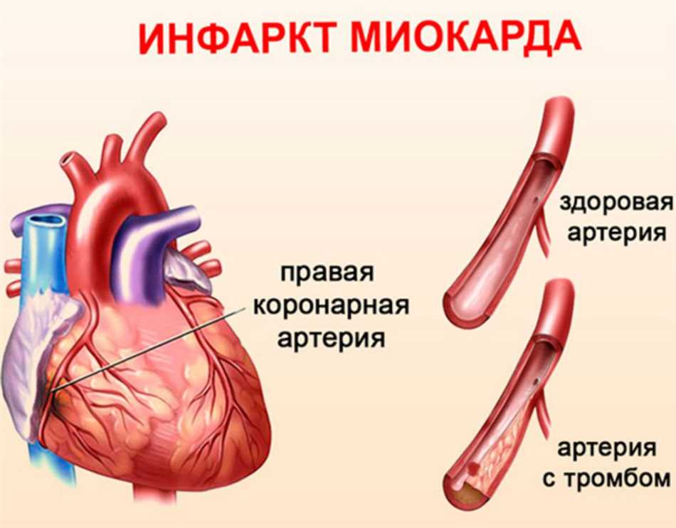 Симптомы ишемического криза