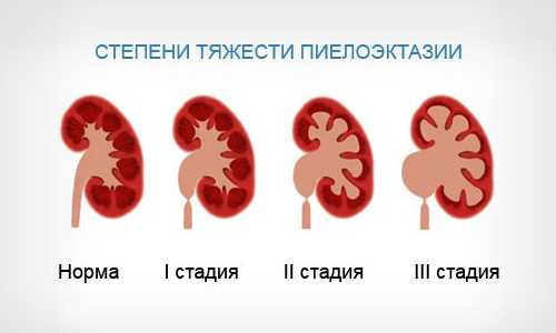 Диагностика каликоэктазии почки