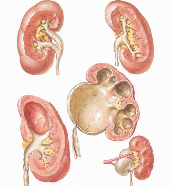 Что такое каликоэктазия почки