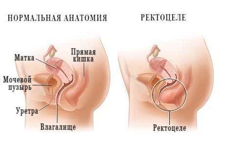 Лечение каловых камней