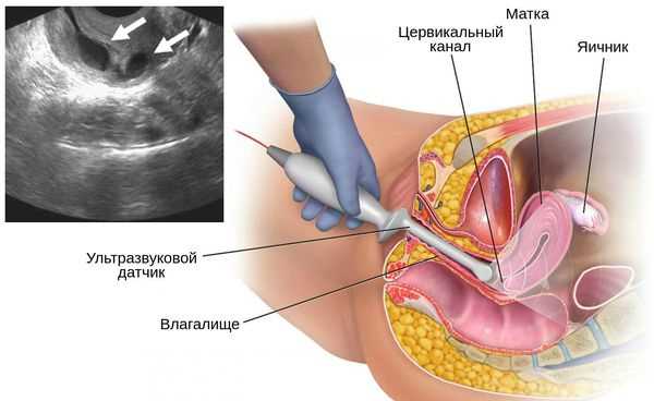 Возможные осложнения при кисте матки