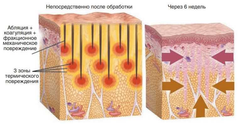 Что такое коагуляция тканей