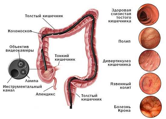 Что такое колонопатия кишечника?