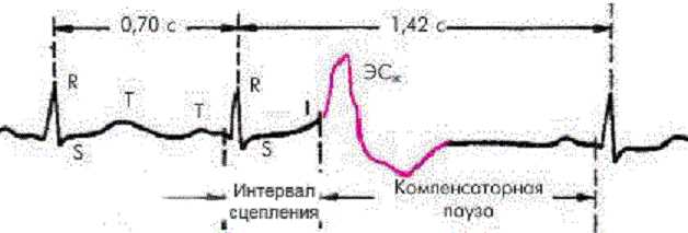 Компенсаторная пауза на ЭКГ: основные понятия и определение