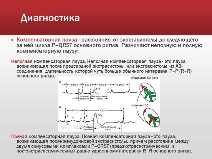 Заболевания сердца и сосудов, вызывающие компенсаторную паузу