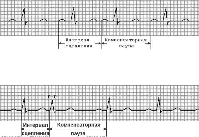 Что такое компенсаторная пауза на ЭКГ?