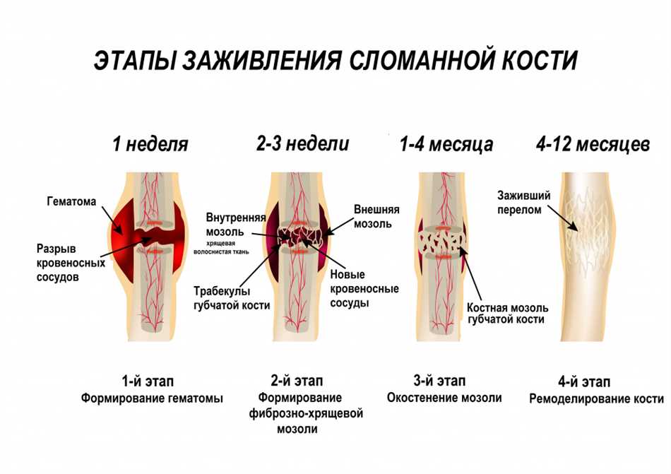 Физиология процесса консолидации перелома кости