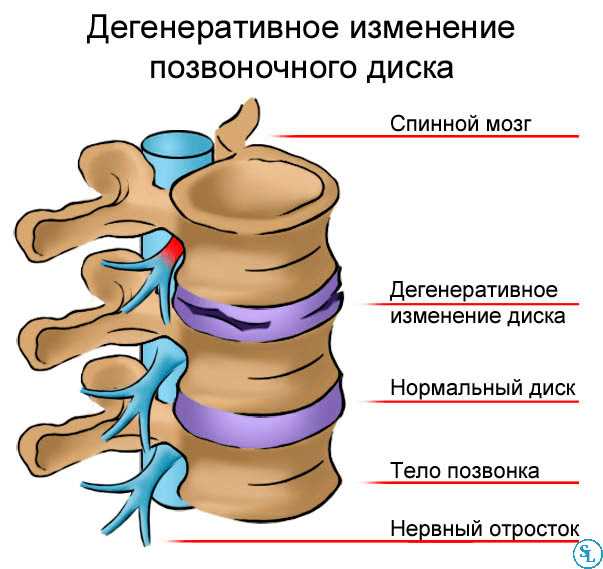 Что такое корешки в области позвоночника S1