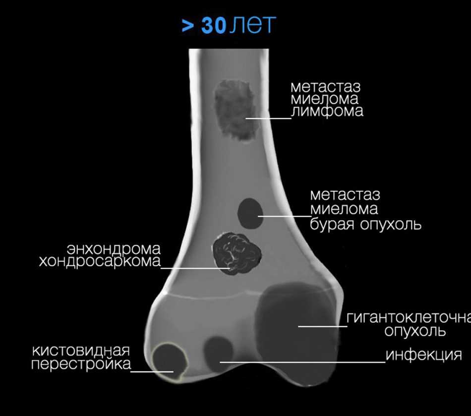 Что такое кортикальный слой кости?