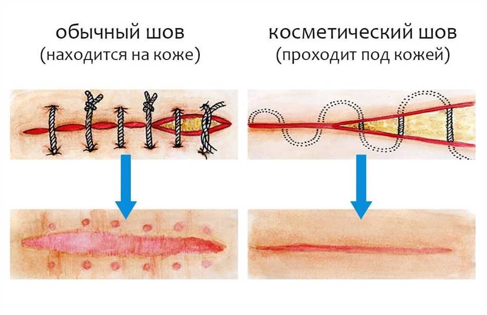 Шов после кесарева сечения