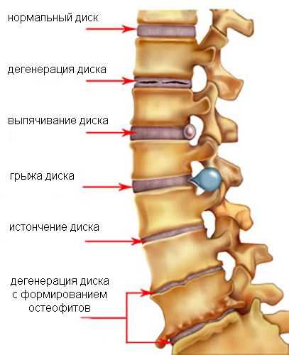 Профилактика краевых костных разрастаний позвоночника