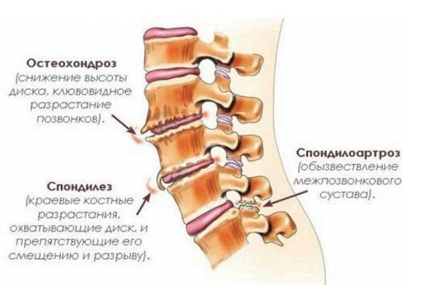 Что такое краевые костные разрастания позвоночника