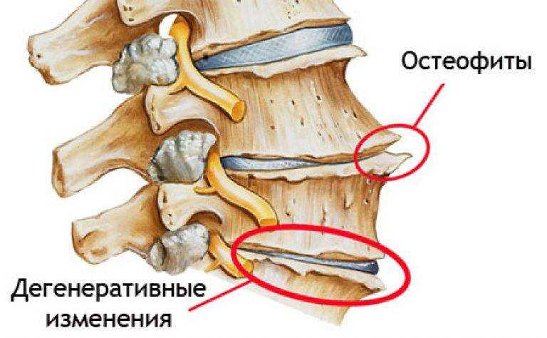 Краевые остеофиты на позвоночнике