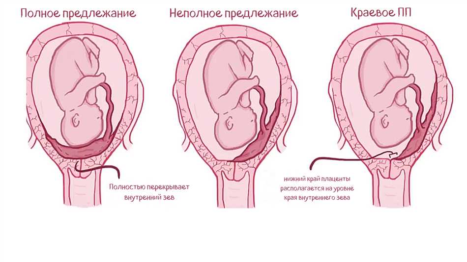 Низкое расположение плаценты при беременности