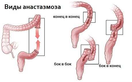 Что такое резекция тонкой кишки