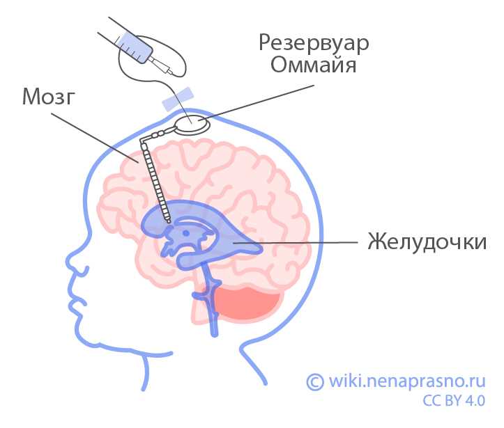 Классификация резервуаров инфекции