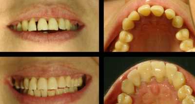 Что такое риббонд в стоматологии