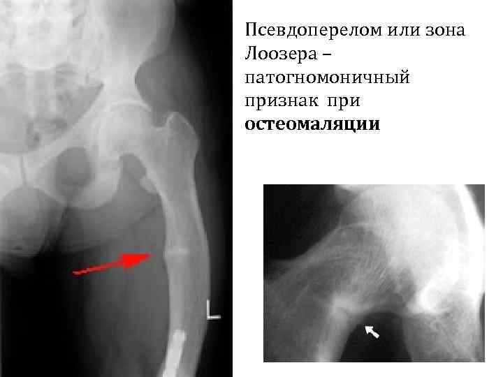 Что такое рыбьи позвонки у человека?