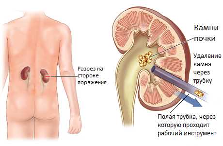 Профилактика рирха