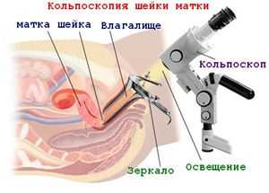 4. Несоответствие или выпадение спирали