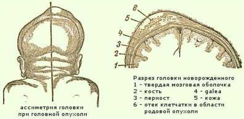 Что такое родовая опухоль и кефалогематома?