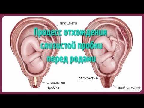 Определение родовой пробки