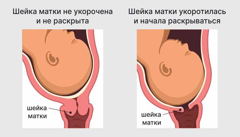 Что такое родовая пробка и как она выглядит