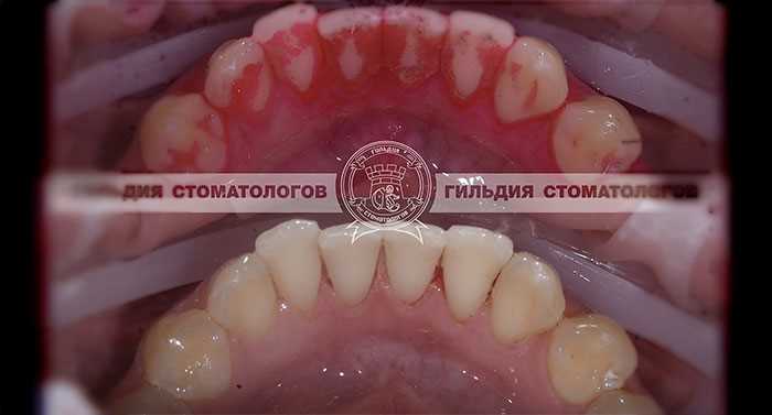 Показания для санации зубов